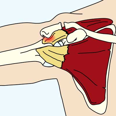 Impingement